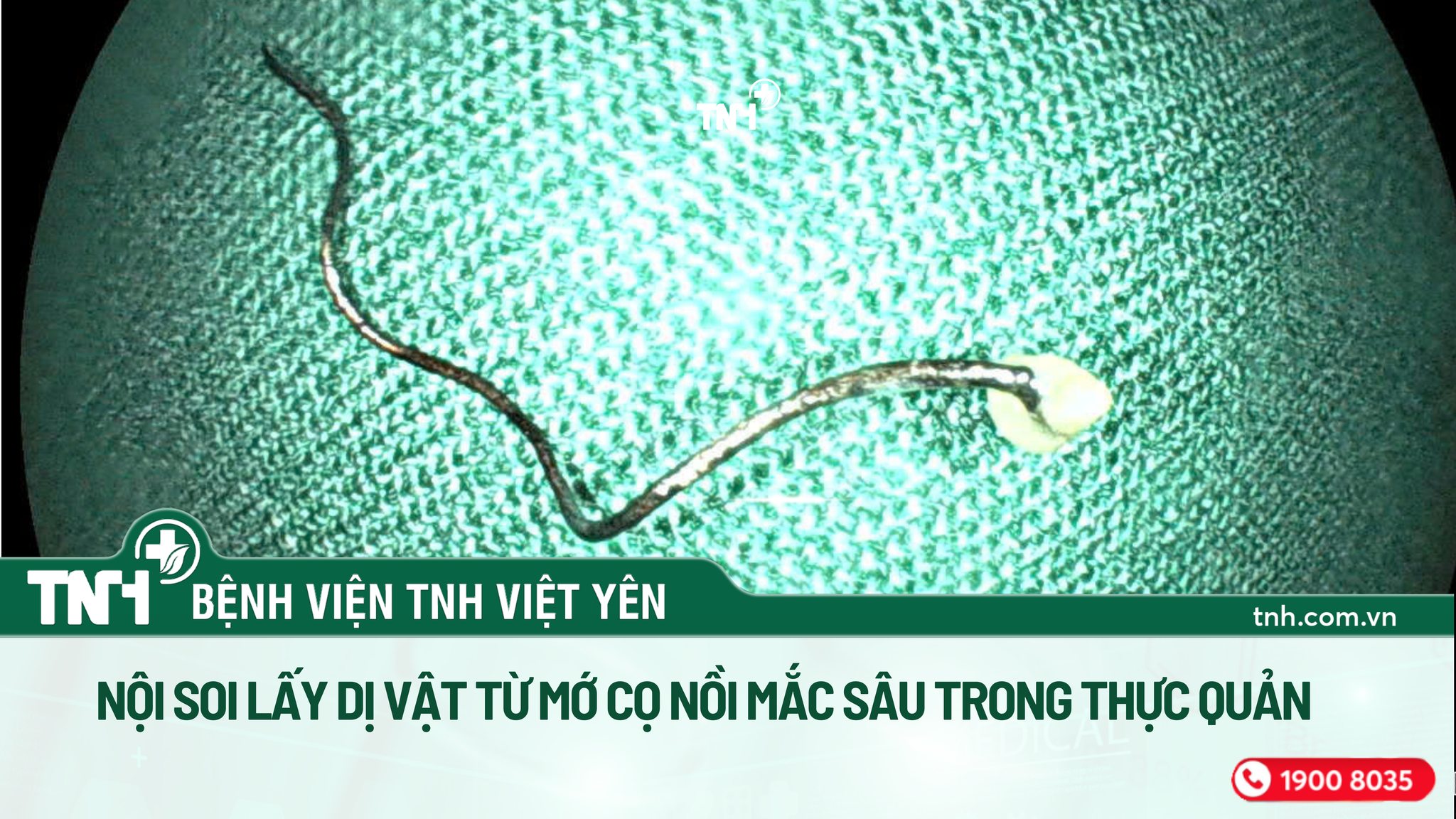 NỘI SOI LẤY DỊ VẬT TỪ MỚ CỌ NỒI MẮC SÂU TRONG THỰC QUẢN