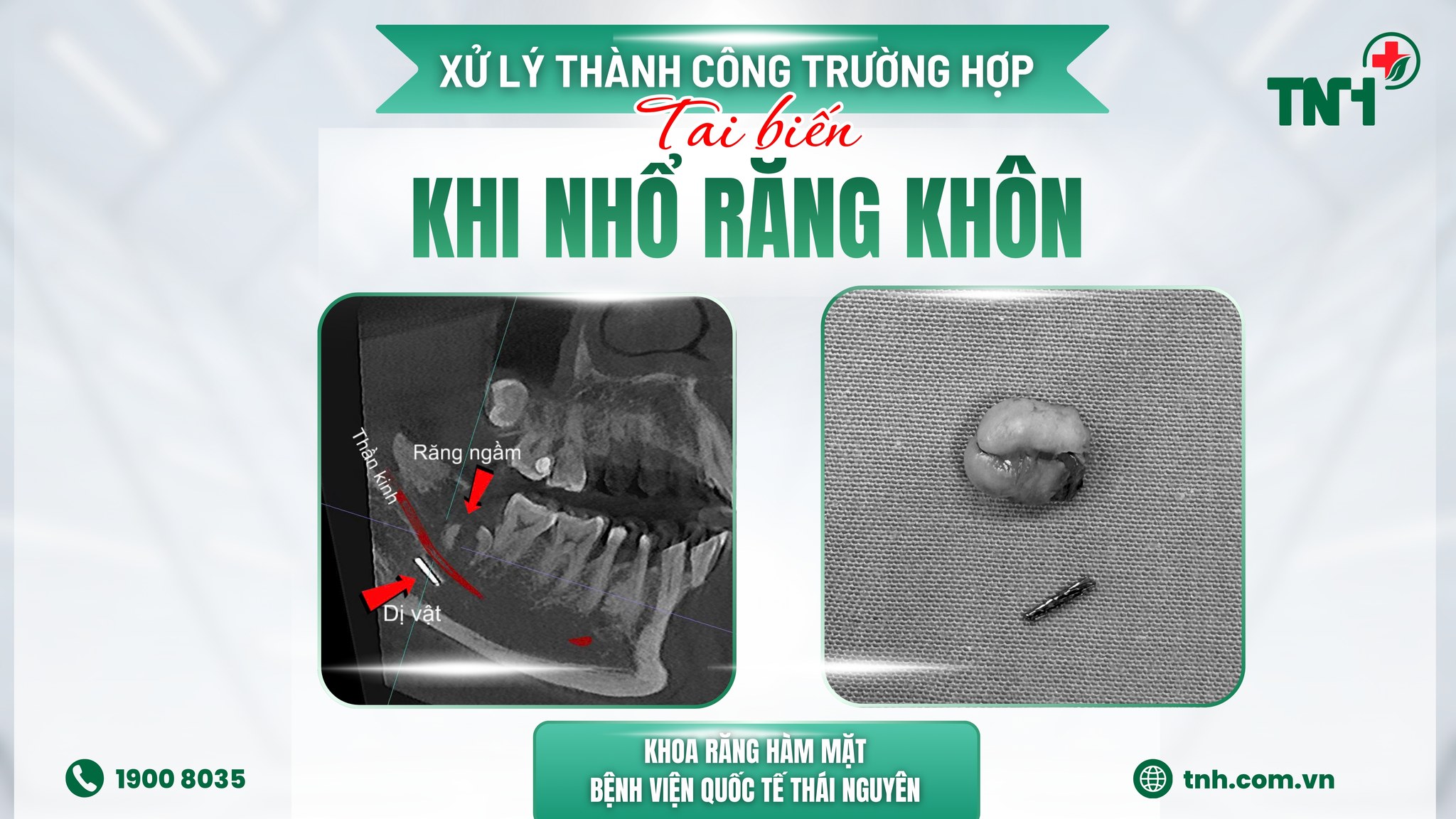 XỬ LÝ THÀNH CÔNG TRƯỜNG HỢP TAI BIẾN KHI NHỔ RĂNG KHÔN