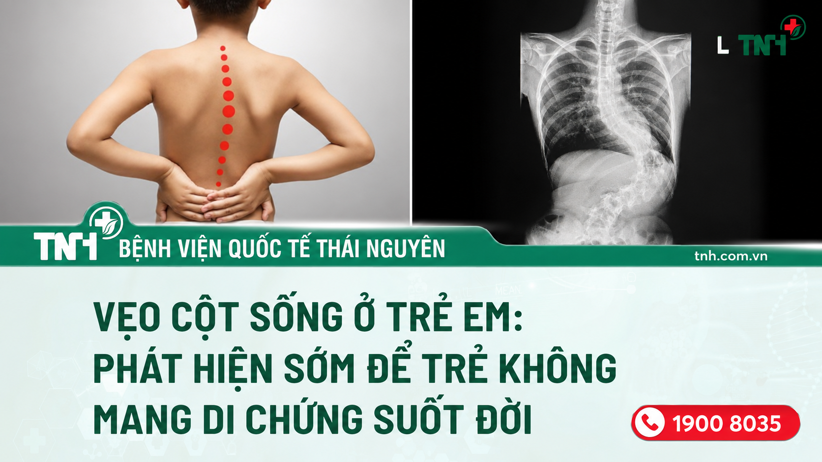 Vẹo cột sống ở trẻ em – Phát hiện sớm để trẻ không mang di chứng suốt đời
