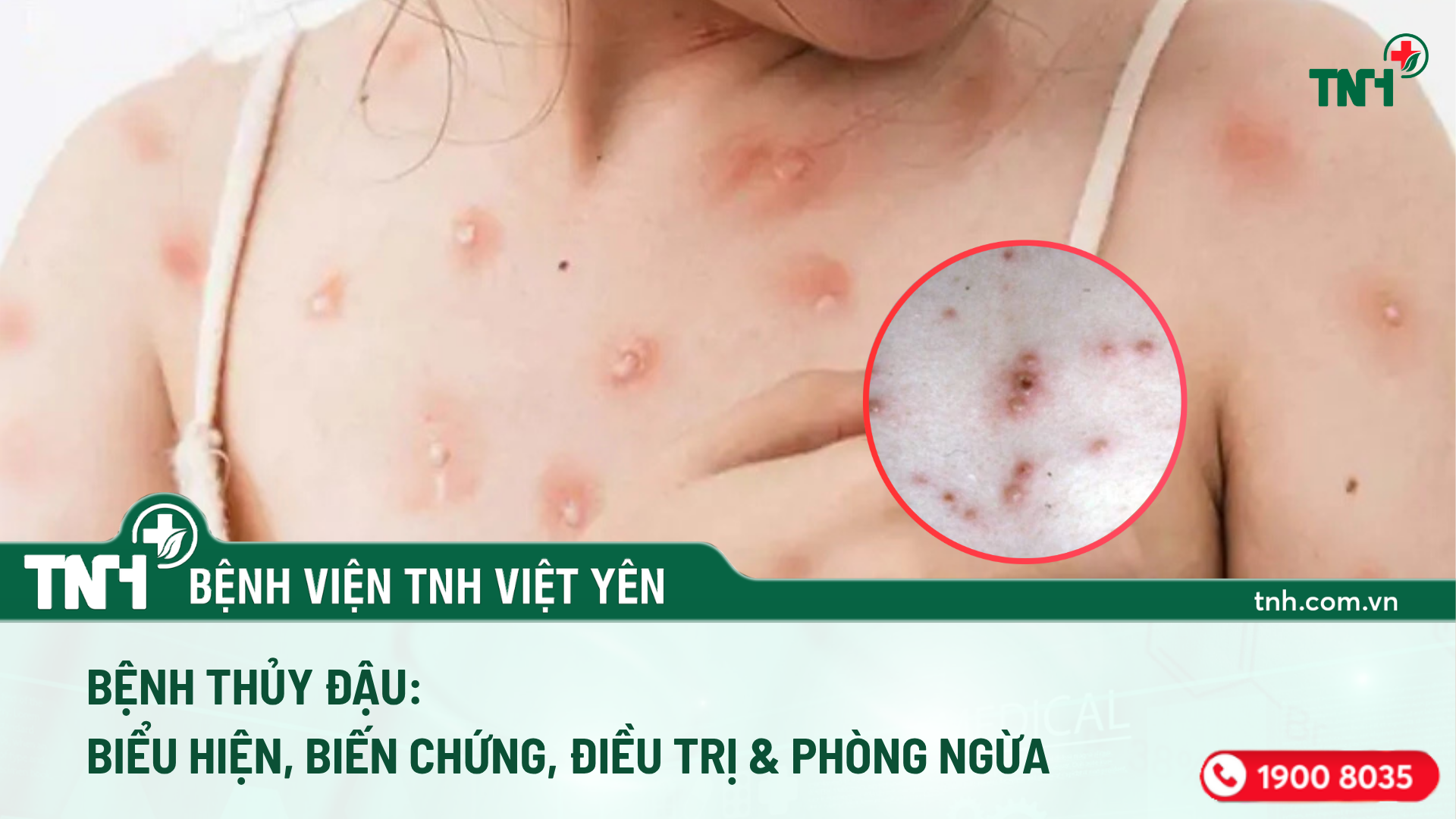 THỦY ĐẬU – NHẬN BIẾT SỚM, ĐIỀU TRỊ ĐÚNG CÁCH ĐỂ TRÁNH BIẾN CHỨNG