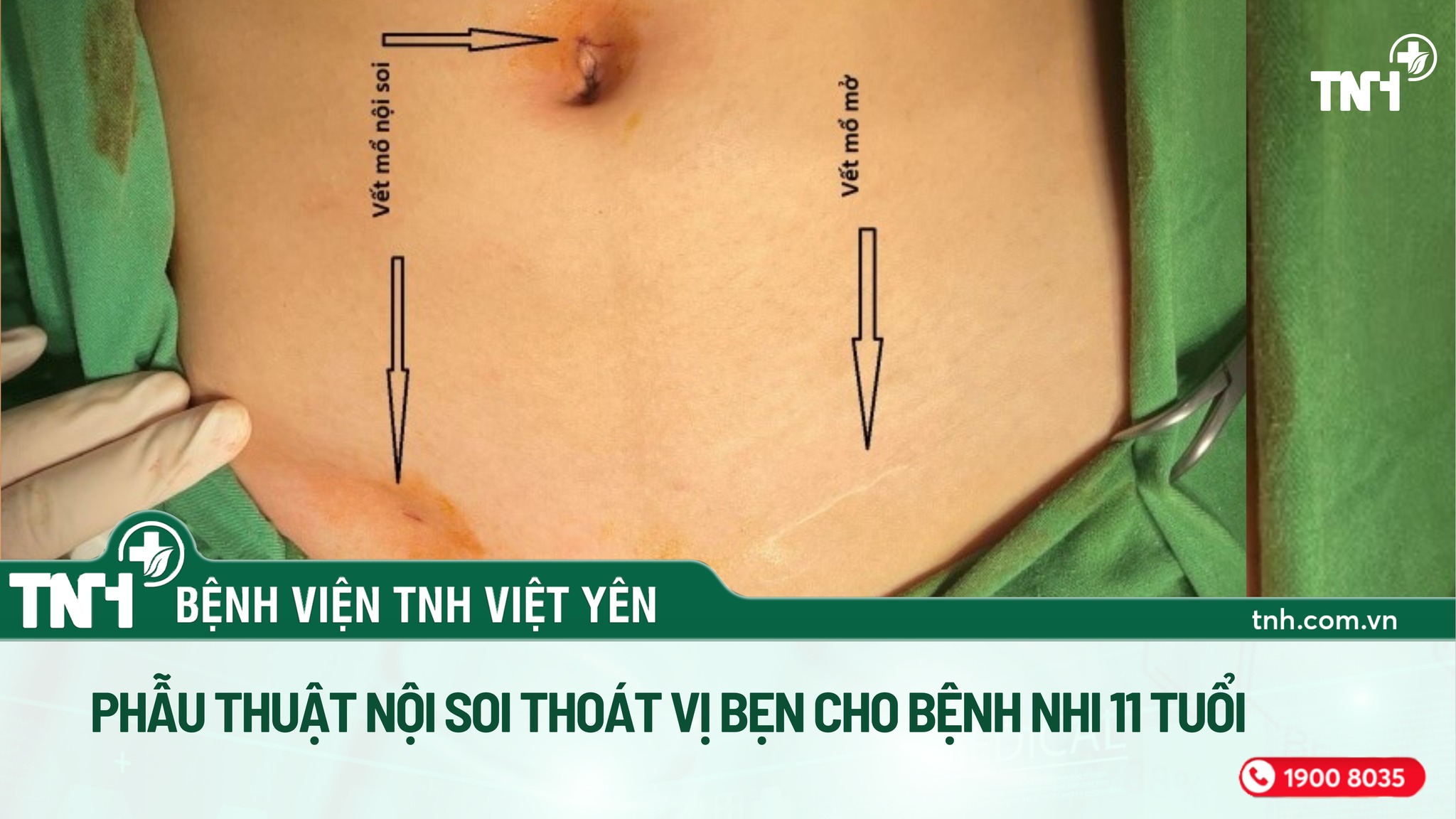 PHẪU THUẬT NỘI SOI THOÁT VỊ BẸN CHO BỆNH NHI 11 TUỔI