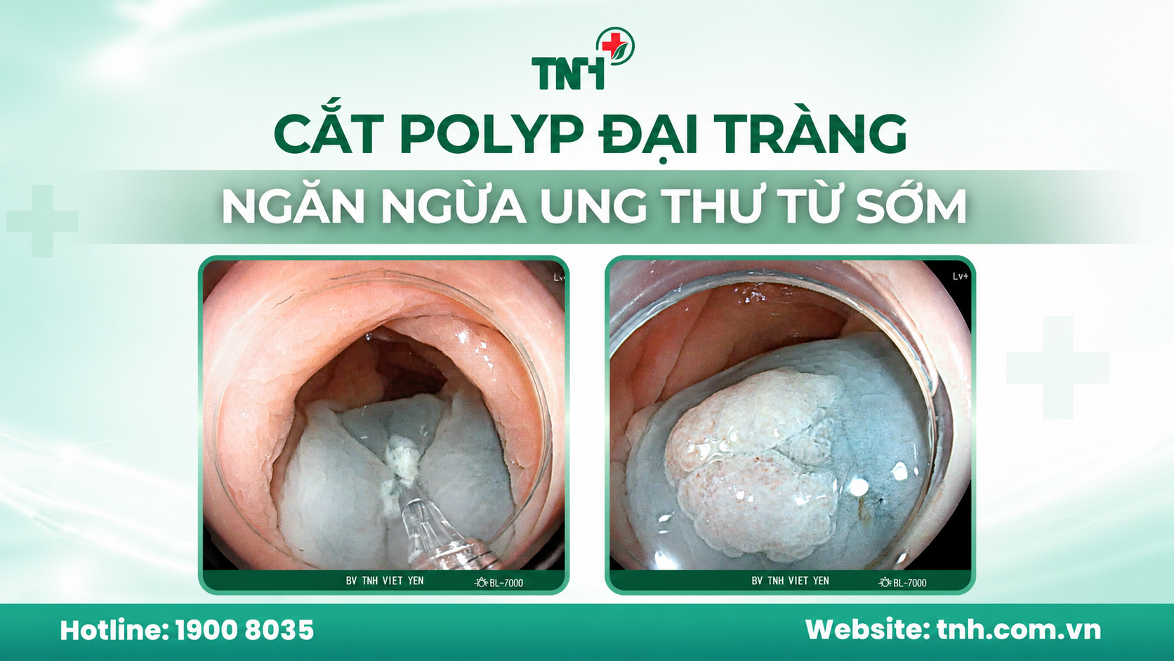 CẮT POLYP ĐẠI TRÀNG - GIẢI PHÁP NGĂN NGỪA UNG THƯ ĐẠI TRỰC TRÀNG TỪ SỚM