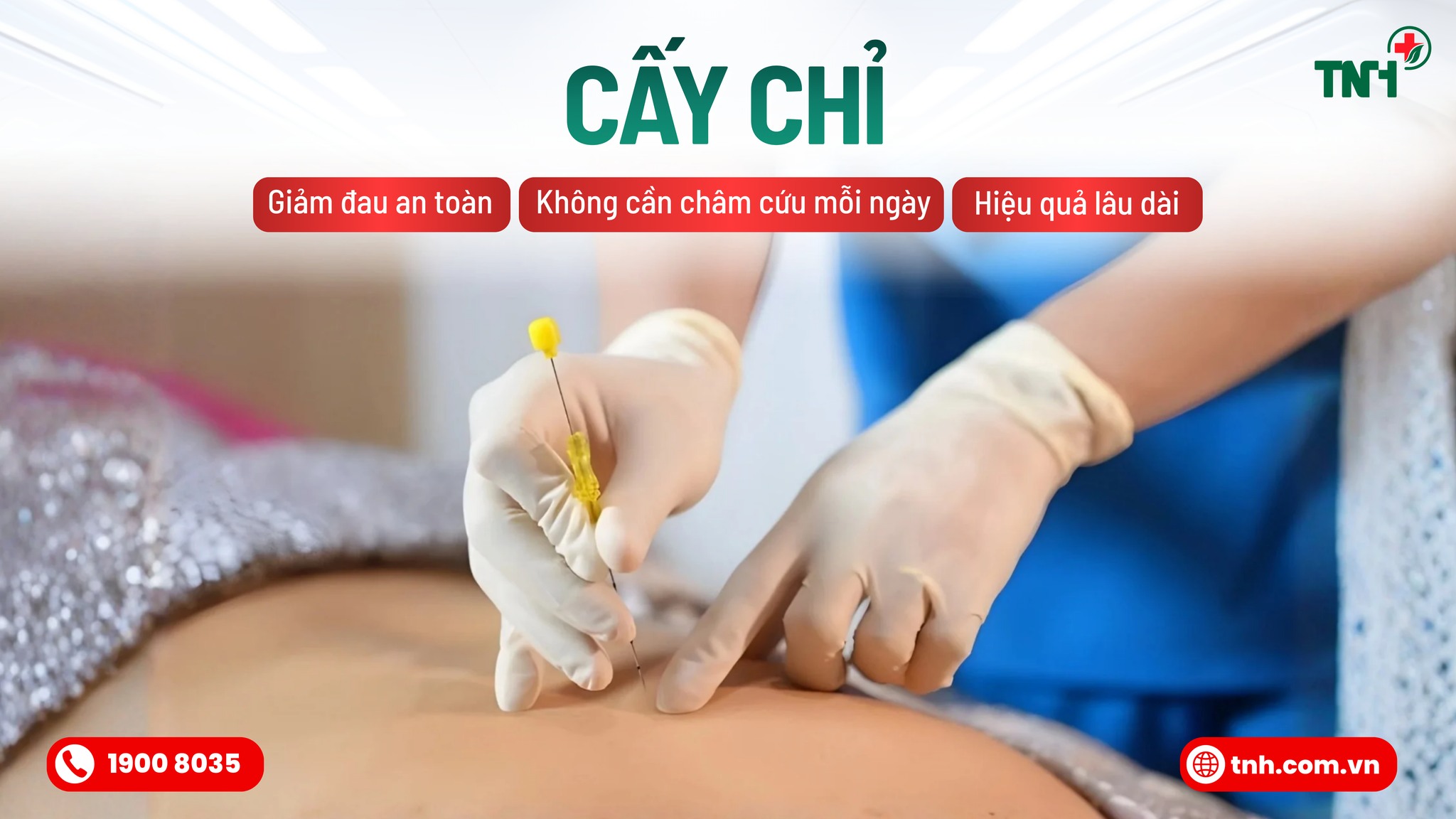 CẤY CHỈ PHƯƠNG PHÁP ĐIỀU TRỊ TIÊN TIẾN, KẾT HỢP TINH HOA CỦA CHÂM CỨU Y HỌC CỔ TRUYỀN VỚI KỸ THUẬT Y HỌC HIỆN ĐẠI
