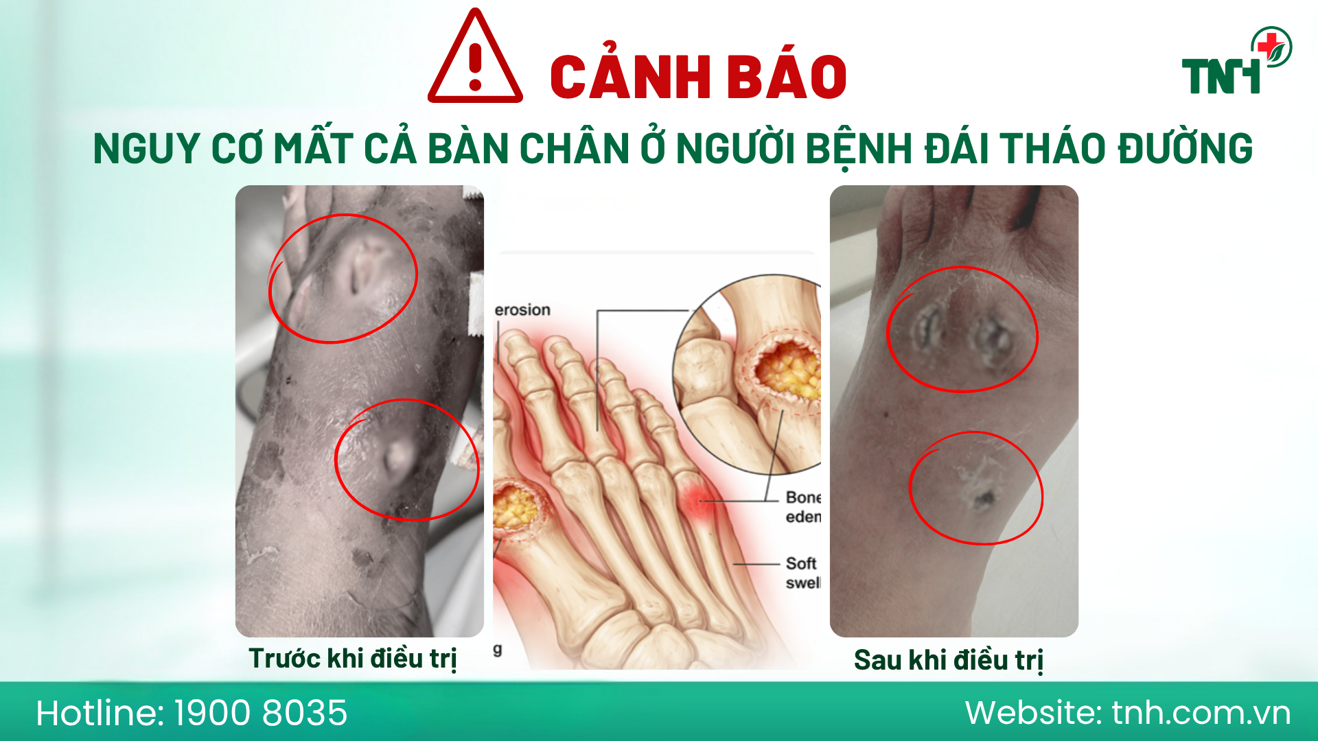 BÁO ĐỘNG: TỪ MỘT VẾT LOÉT NHỎ - NGUY CƠ MẤT CẢ BÀN CHÂN Ở NGƯỜI BỆNH ĐÁI THÁO ĐƯỜNG