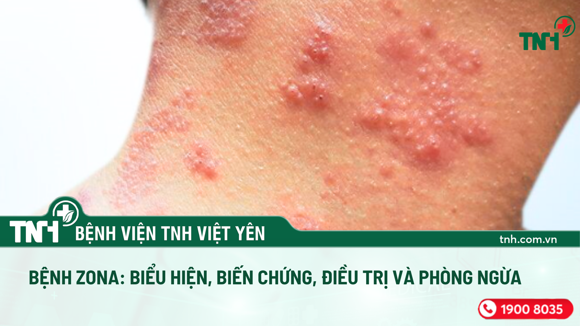 BỆNH ZONA – NHẬN BIẾT SỚM, ĐIỀU TRỊ KỊP THỜI ĐỂ HẠN CHẾ BIẾN CHỨNG