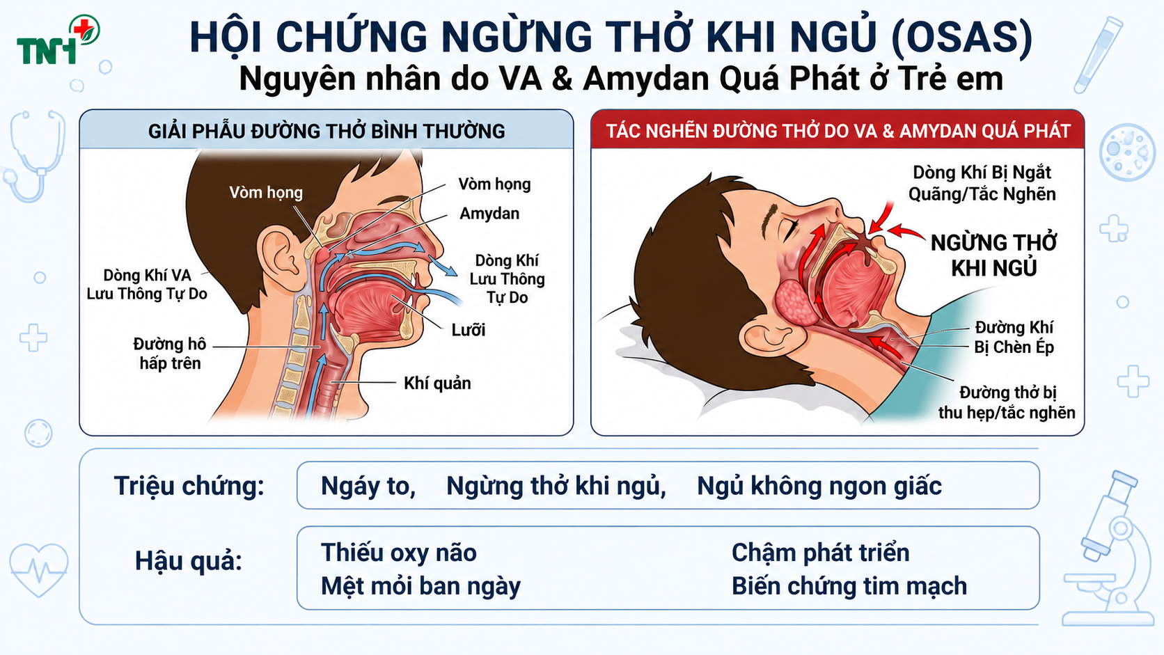 ĐỪNG ĐỂ TRẺ “HỤT HƠI” MỖI ĐÊM: NHẬN BIẾT SỚM HỘI CHỨNG NGƯNG THỞ KHI NGỦ Ở TRẺ EM
