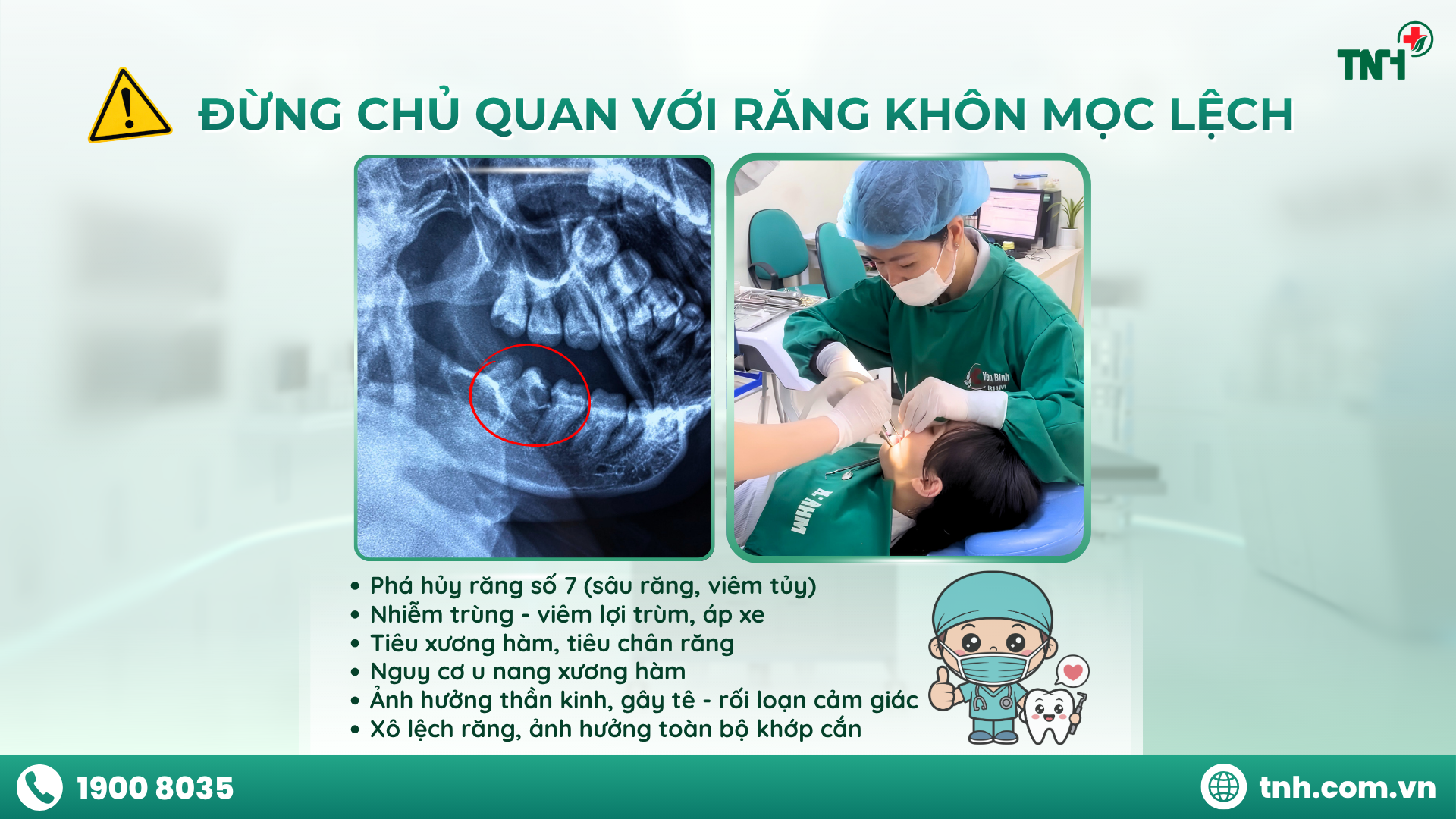 RĂNG KHÔN MỌC LỆCH: NGUY CƠ BIẾN CHỨNG KHÔN LƯỜNG!