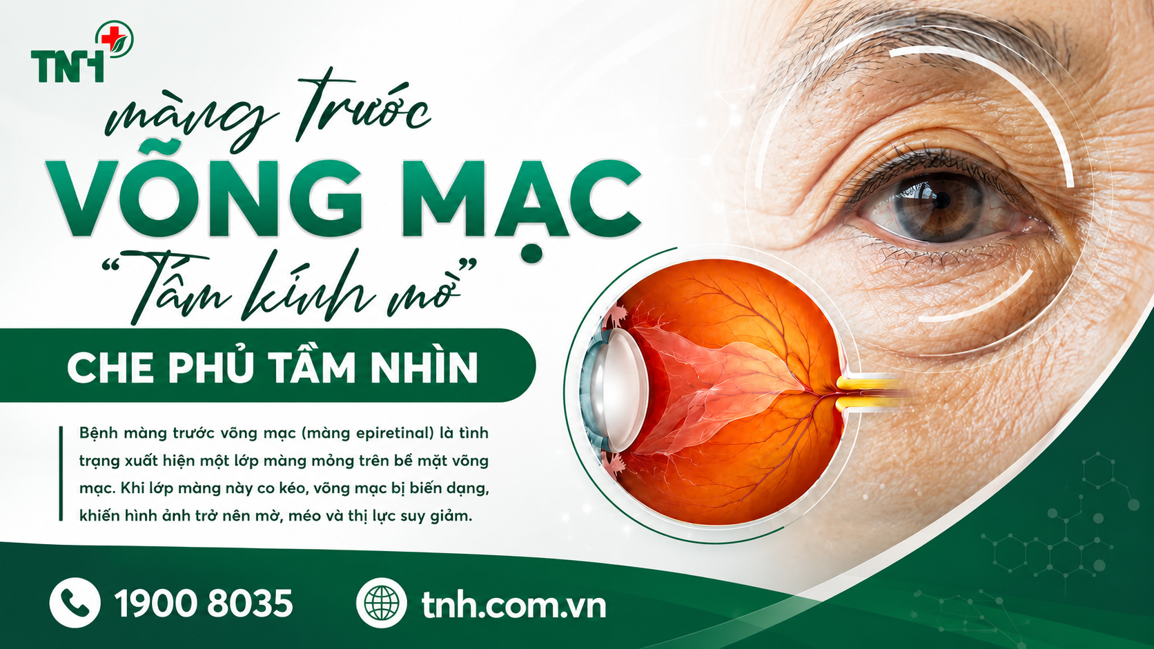 MÀNG TRƯỚC VÕNG MẠC - ĐỪNG ĐỂ THỊ LỰC GIẢM DẦN MÀ KHÔNG HAY BIẾT