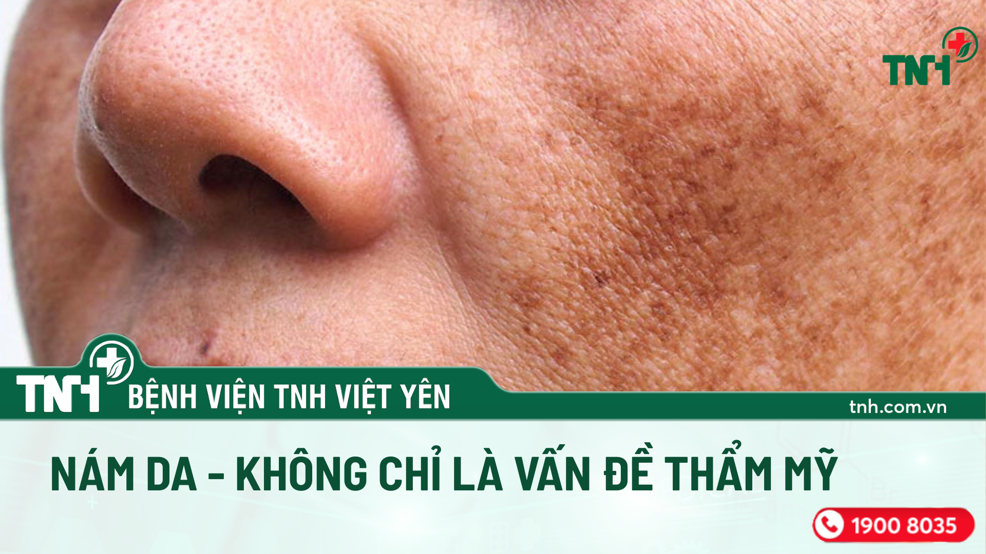 Nám da – Không chỉ là vấn đề thẩm mỹ