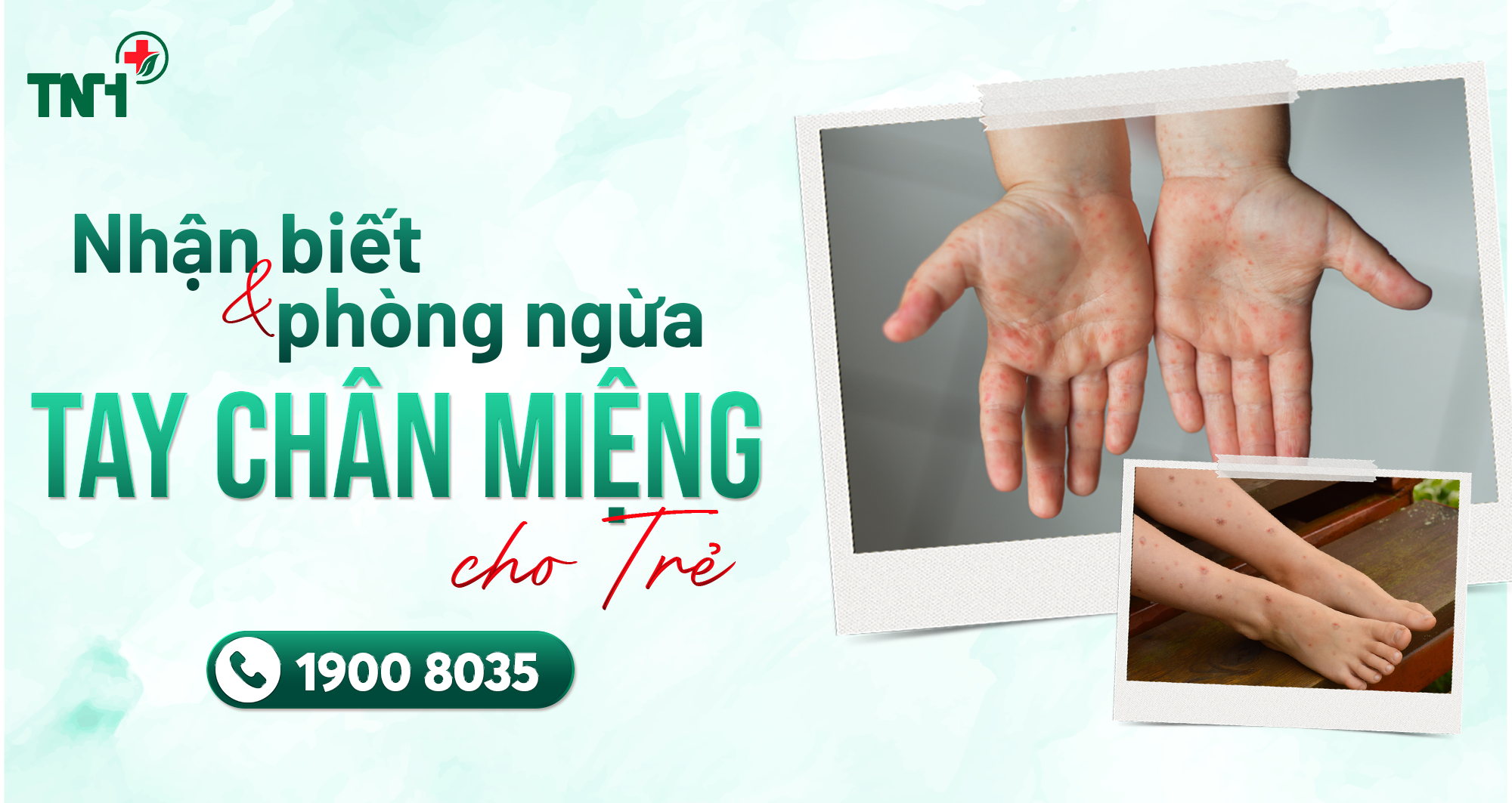 CẢNH BÁO GIA TĂNG BỆNH TAY CHÂN MIỆNG: HƯỚNG DẪN NHẬN BIẾT VÀ PHÒNG NGỪA