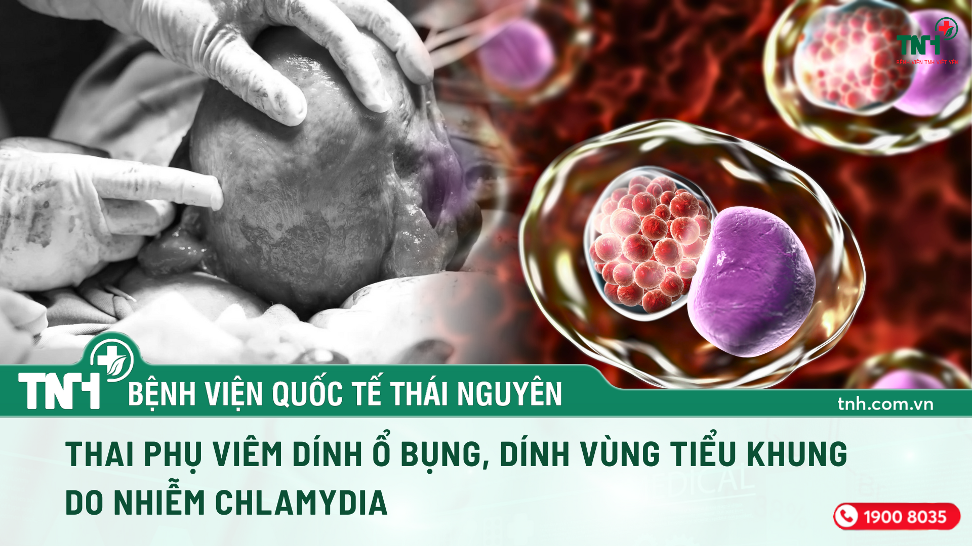 THAI PHỤ VIÊM DÍNH Ổ BỤNG, DÍNH VÙNG TIỂU KHUNG DO NHIỄM CHLAMYDIA