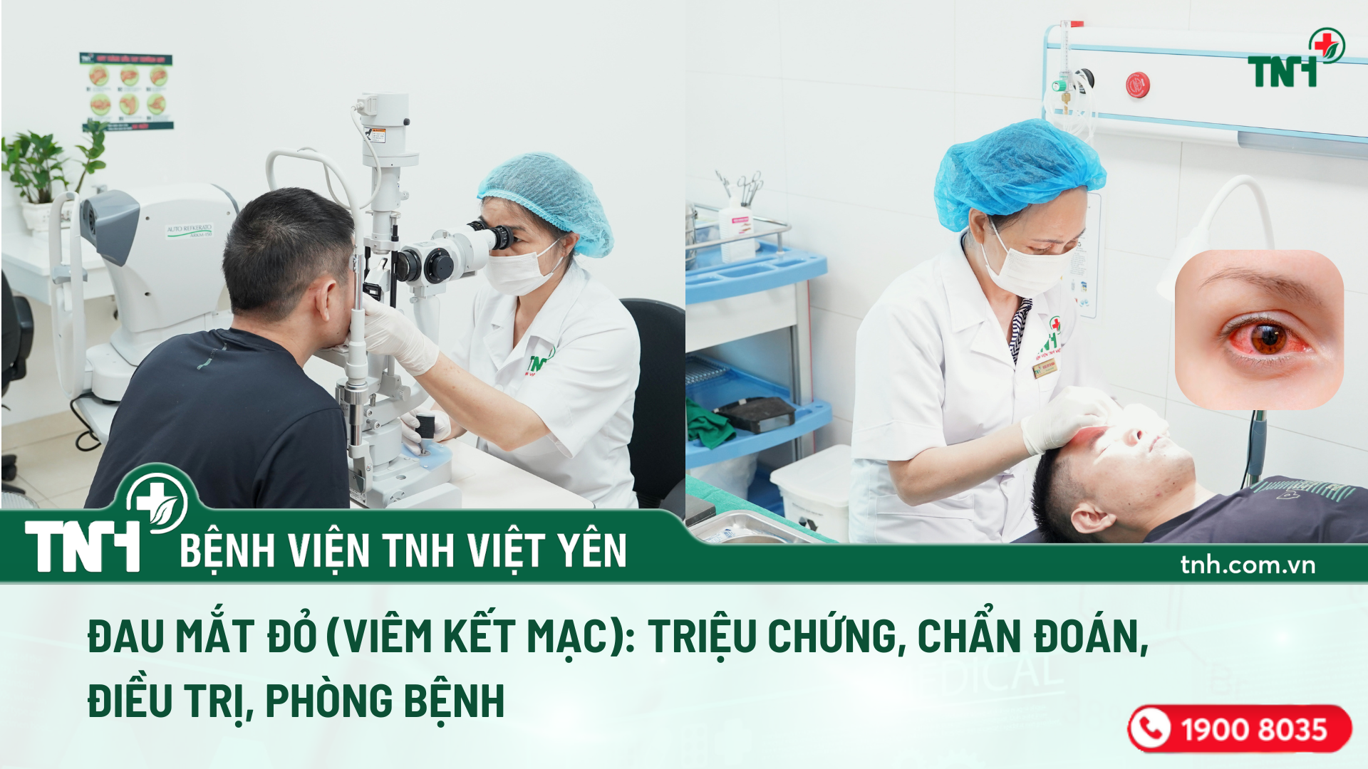 ĐAU MẮT ĐỎ (VIÊM KẾT MẠC): TRIỆU CHỨNG, CHẨN ĐOÁN, ĐIỀU TRỊ, PHÒNG BỆNH