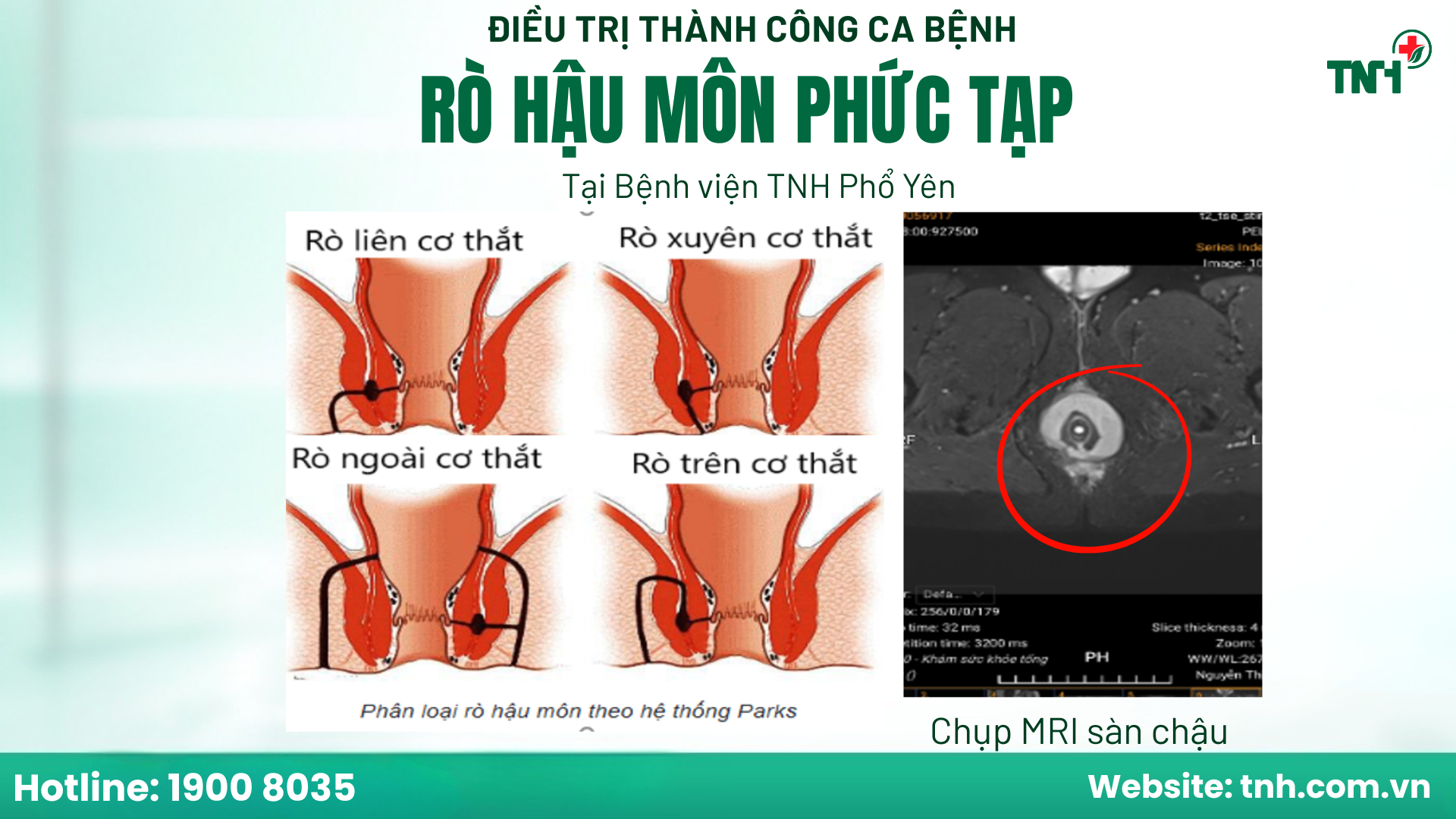 ĐAU HẬU MÔN KÉO DÀI - CẢNH BÁO NGUY CƠ ÁP XE, TIẾN TRIỂN RÒ HẬU MÔN