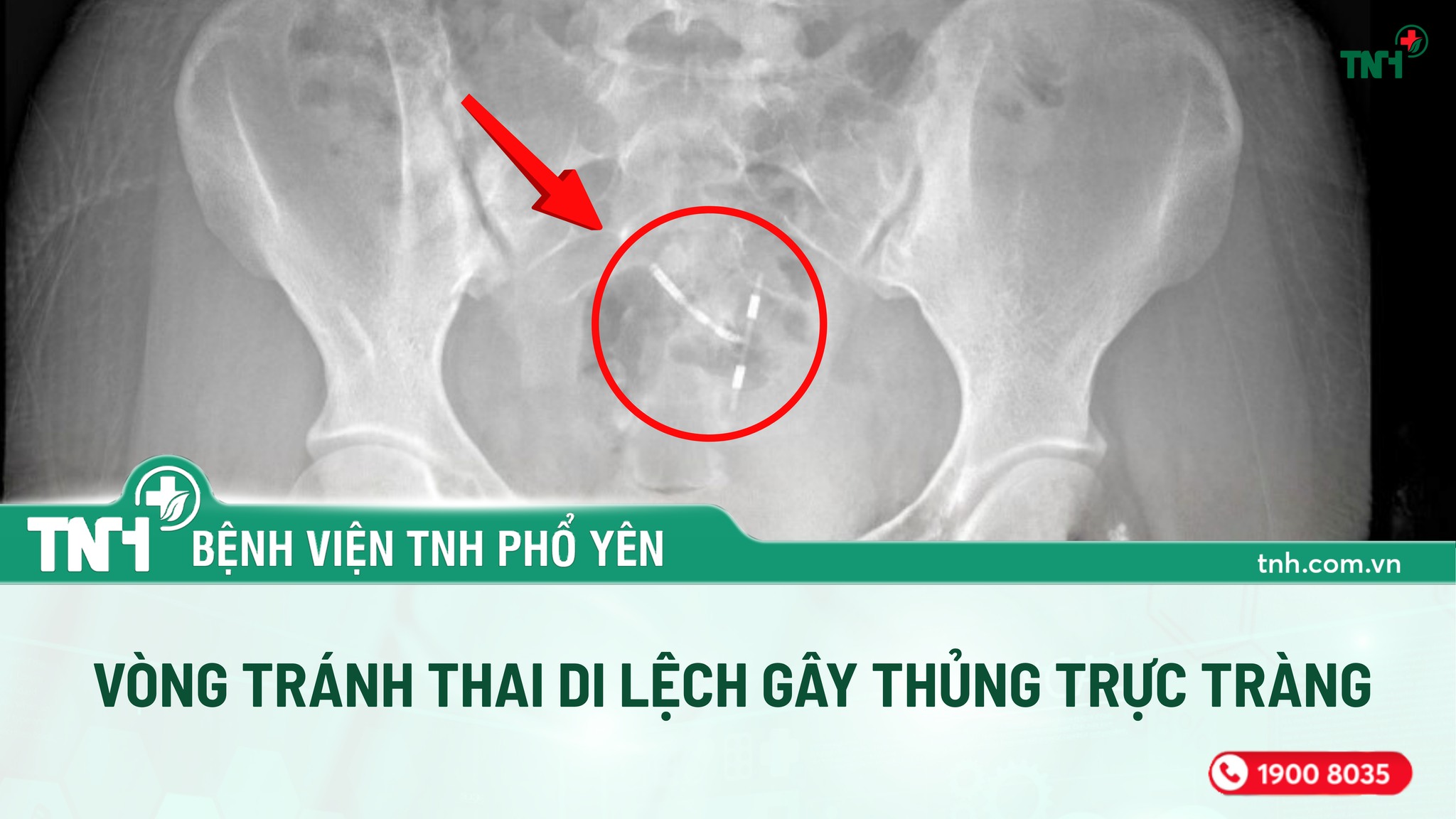 VÒNG TRÁNH THAI GÂY THỦNG THÀNH TRỰC TRÀNG
