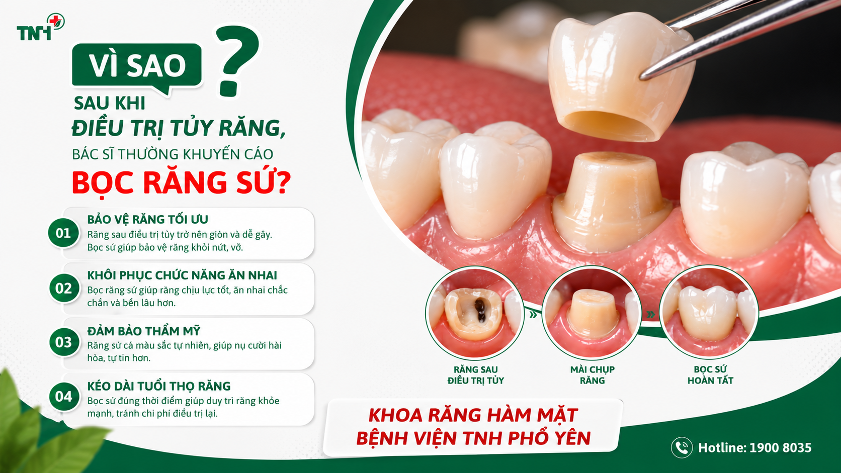 Vì sao sau khi điều trị tủy răng, bác sĩ thường khuyến cáo bọc răng sứ?